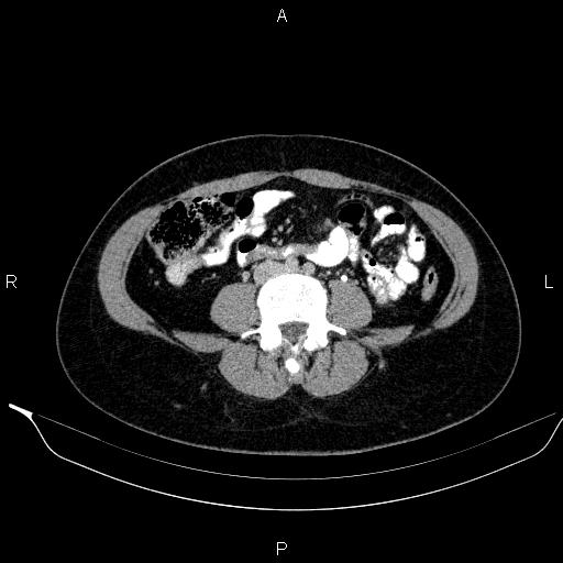Bilateral adrenal myelolipoma (Radiopaedia 63058-71535 Axial C+ delayed 89).jpg