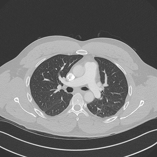 Bilateral atelectasis (Radiopaedia 48666-53675 Axial lung window 47).jpg
