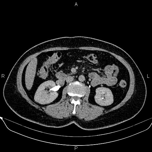 Bilateral benign adrenal adenomas (Radiopaedia 86912-103124 Axial C+ delayed 67).jpg