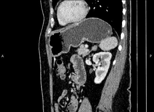 Bilateral benign adrenal adenomas (Radiopaedia 86912-103124 E 68).jpg