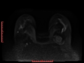 File:Bilateral breast implant rupture (Radiopaedia 24761-25027 DWI 16).jpg