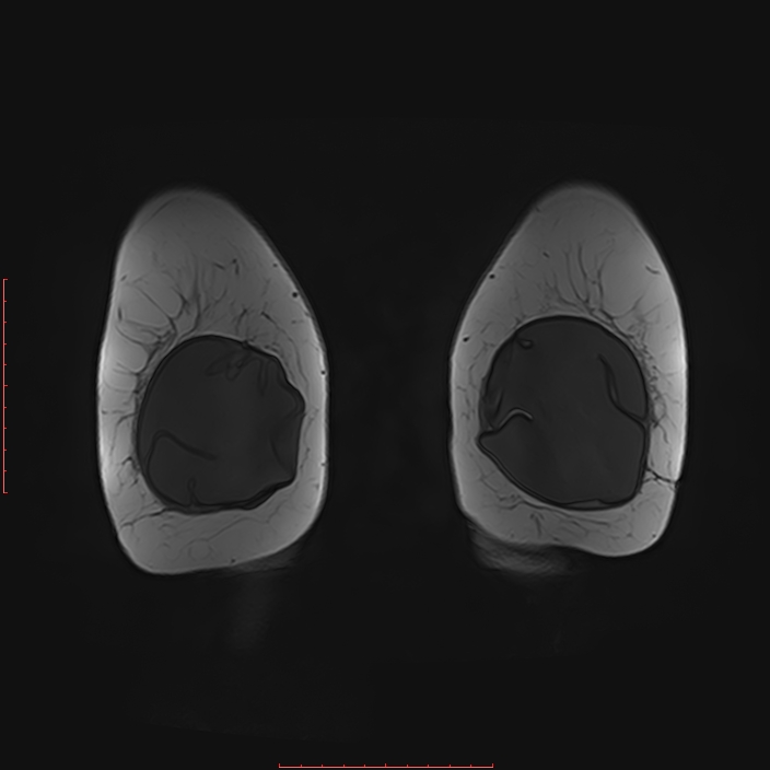 Bilateral breast implant rupture (Radiopaedia 24761-25027 G 85).jpg