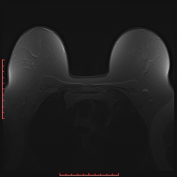 File:Bilateral breast implant rupture (Radiopaedia 24761-25027 PASTA 5).jpg
