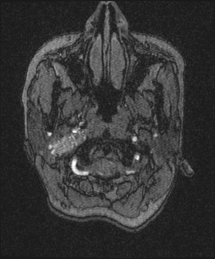 Bilateral carotid body tumors and right glomus jugulare tumor (Radiopaedia 20024-20060 Axial MRA 1).jpg