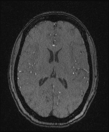 Bilateral carotid body tumors and right glomus jugulare tumor (Radiopaedia 20024-20060 Axial MRA 109).jpg