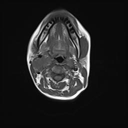 File:Bilateral carotid body tumors and right jugular paraganglioma (Radiopaedia 20024-20060 Axial 5).jpg