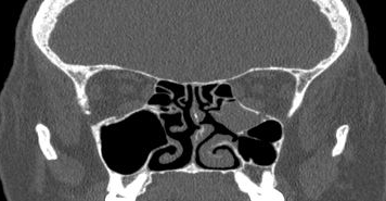 File:Bilateral ectopic infraorbital nerves (Radiopaedia 49006-54084 Coronal 26).png