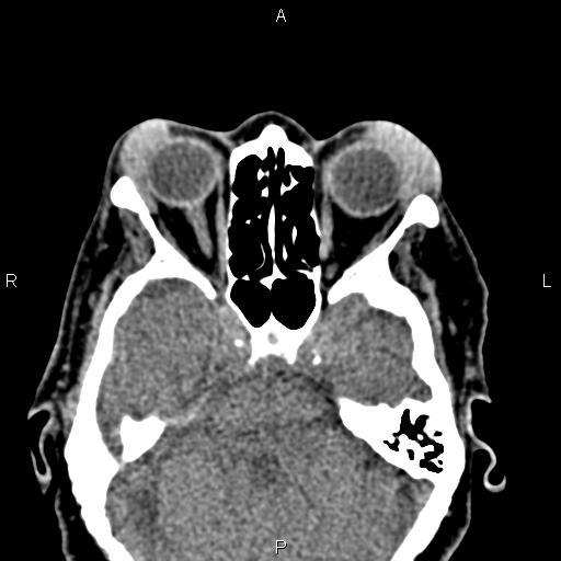 Bilateral enlargement of lacrimal glands - sarcoidosis (Radiopaedia 62627-70921 Axial non-contrast 44).jpg
