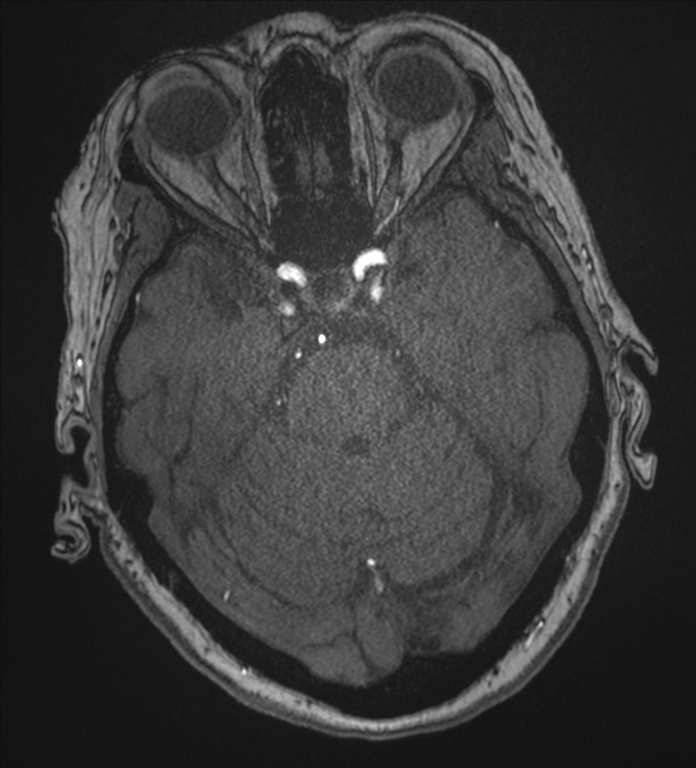 Bilateral fetal posterior communicating arteries (Radiopaedia 41286-44102 Axial MRA 63).png