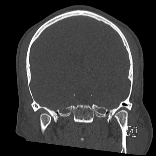 Bilateral occipital condyle fracture (type 2) (Radiopaedia 87675-104089 Coronal bone window 63).jpg