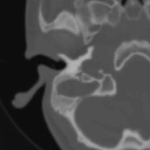 Bilateral otosclerosis (Radiopaedia 57237-64157 B 27).jpg