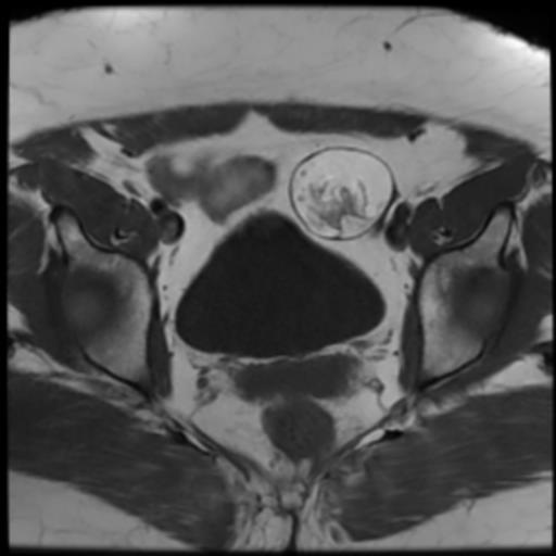 File:Bilateral ovarian dermoid cysts (Radiopaedia 90152-107338 Axial T1 14).jpg