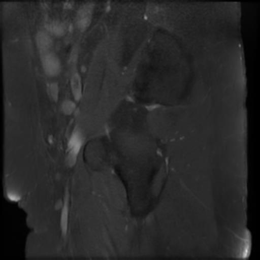 File:Bilateral ovarian dermoid cysts (Radiopaedia 90152-107338 Sagittal T1 C+ 3).jpg