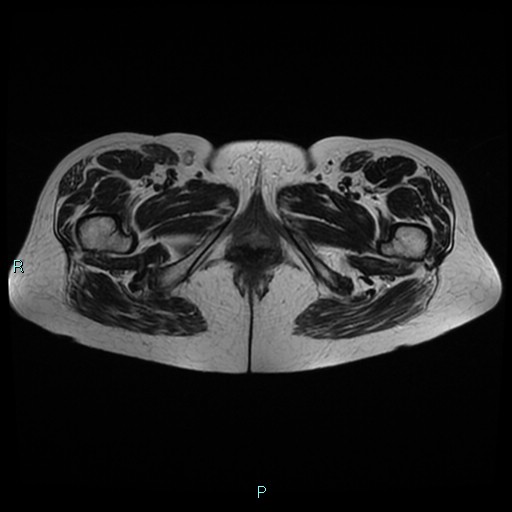 File:Bilateral ovarian fibroma (Radiopaedia 44568-48293 Axial T2 31).jpg