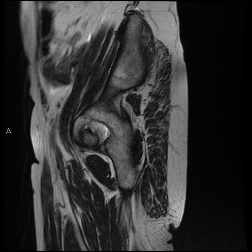 File:Bilateral ovarian fibroma (Radiopaedia 44568-48293 Sagittal T2 32).jpg