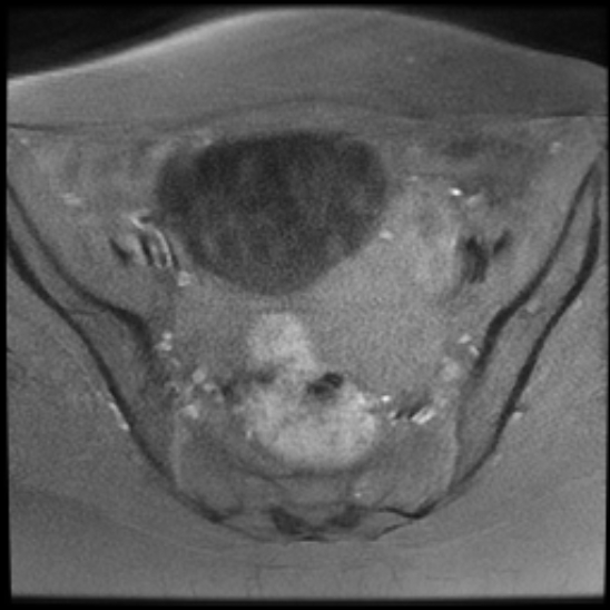 File:Bilateral ovarian fibrothecomas - adolescent (Radiopaedia 86604-102707 Axial T1 fat sat 14).jpg
