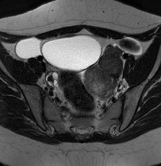 File:Bilateral ovarian fibrothecomas - adolescent (Radiopaedia 86604-102707 Axial T2 17).jpg