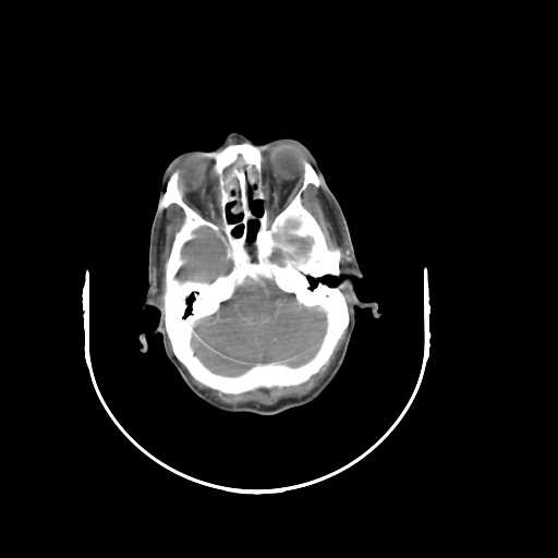 Bilateral parotid gland lymphoma (Radiopaedia 21038-20969 A 3).jpg