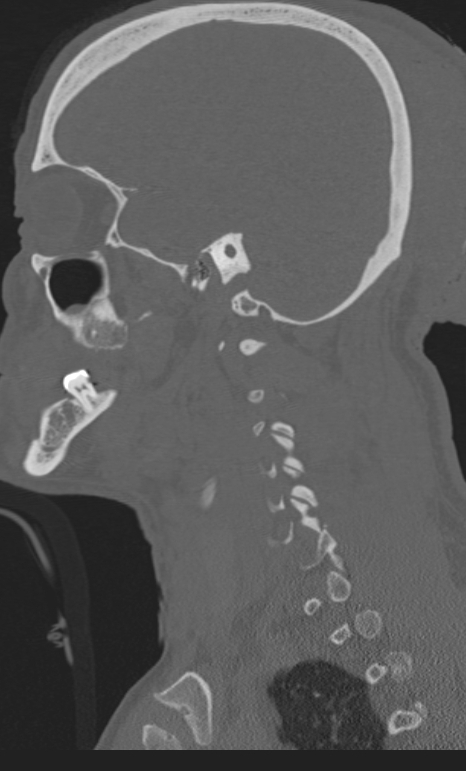 Bilateral perched facet joint (Radiopaedia 63149-71669 Sagittal bone window 64).jpg