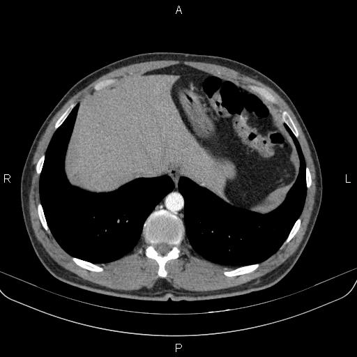 Bilateral pulmonary AVM (Radiopaedia 83134-97505 A 62).jpg