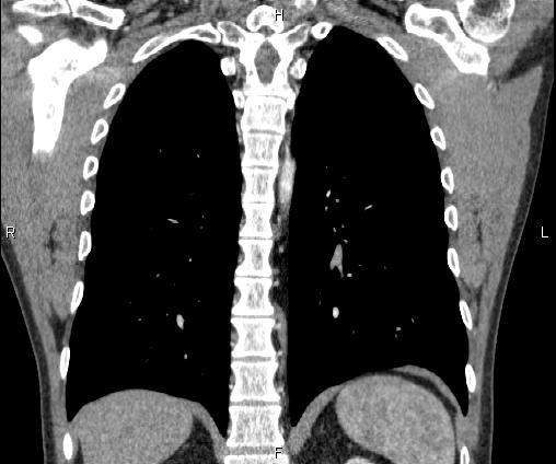 Bilateral pulmonary AVM (Radiopaedia 83134-97505 C 53).jpg