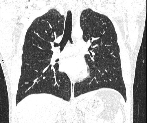 Bilateral pulmonary AVM (Radiopaedia 83134-97505 Coronal lung window 45).jpg