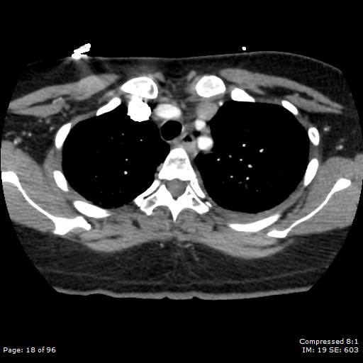 File:Bilateral pulmonary emboli with Hampton hump sign (Radiopaedia 54070-60246 Axial C+ CTPA 15).jpg