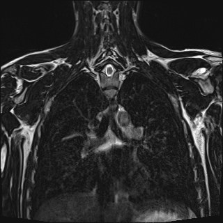 Bilateral spinoglenoid notch ganglion cysts (Radiopaedia 29577-30082 Coronal T2 77).jpg