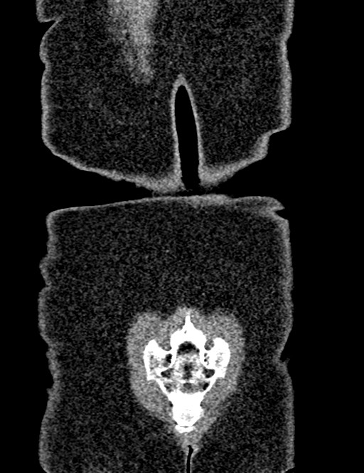 Bilateral staghorn calculi (Radiopaedia 59475-66842 Coronal non-contrast 93).jpg