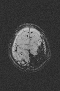 Bilateral subdural hemorrhage and parietal skull fracture (Radiopaedia 26058-26190 Axial SWI 73).png