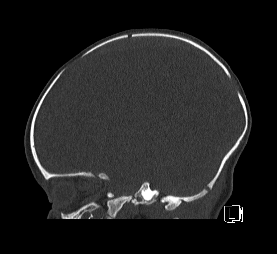 Bilateral subdural hemorrhage and parietal skull fracture (Radiopaedia 26058-26192 Sagittal bone window 62).png