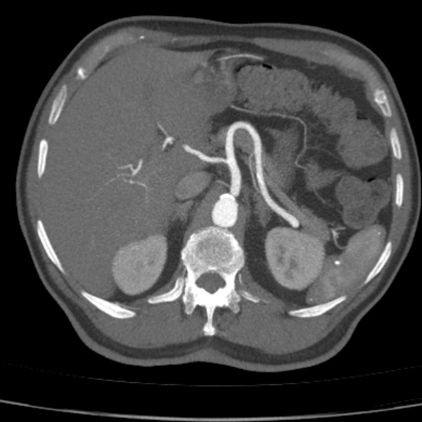 Bilateral superficial femoral arterial occlusion (Radiopaedia 25682-25857 A 5).jpg