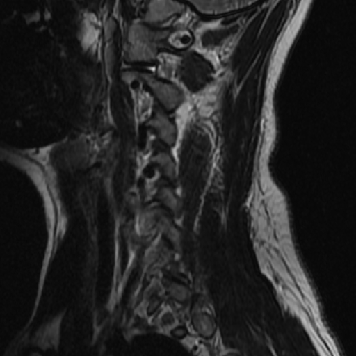 File:Bilateral tortuous vertebral arteries (Radiopaedia 19070-19039 Sagittal T2 1).jpg
