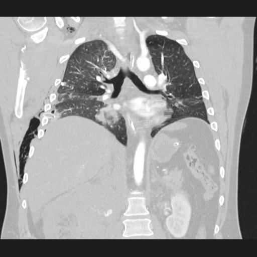 Bilateral traumatic renovascular injury (Radiopaedia 32051-32995 Coronal lung window 47).jpg