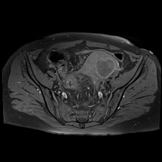 Bilateral tubo-ovarian abscesses (Radiopaedia 58635-65829 Axial T1 fat sat 14).jpg