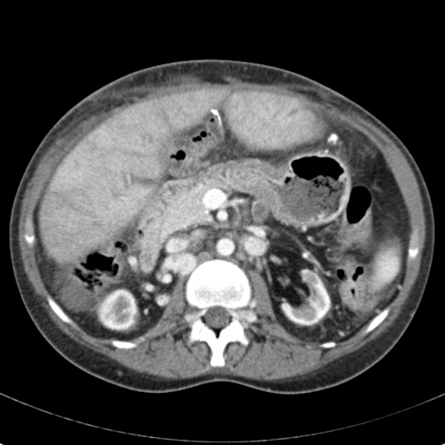 Biliary necrosis - liver transplant (Radiopaedia 21876-21846 B 30).jpg