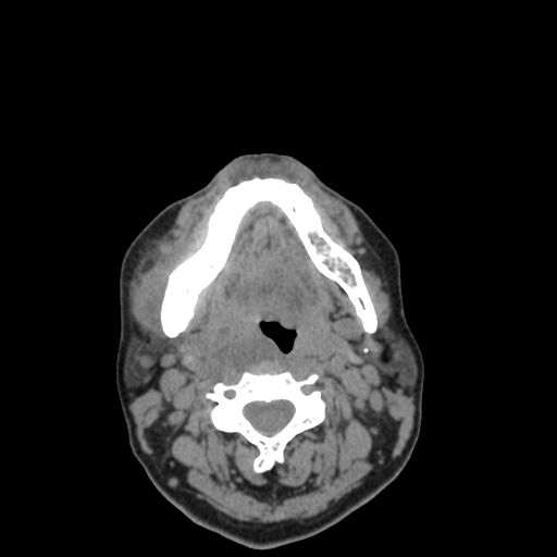 Bisphosphonate-related osteonecrosis of the jaw (Radiopaedia 71324-81642 non-contrast 57).jpg