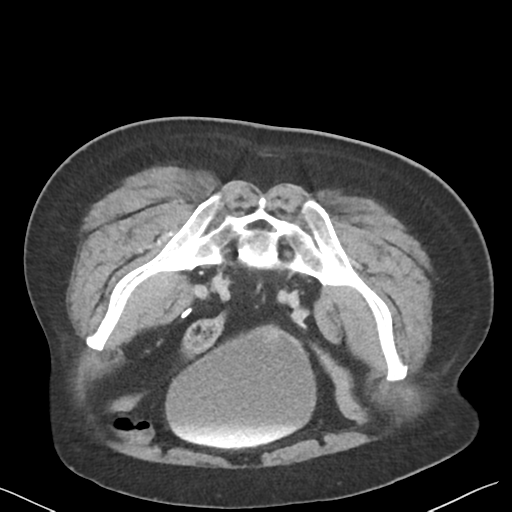 File:Bladder papillary urothelial carcinoma (Radiopaedia 48119-52951 Axial C+ delayed 44).png