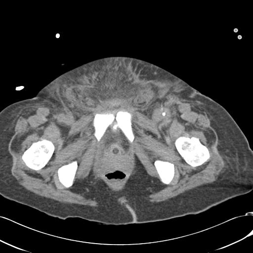 Bladder rupture post renal biopsy (Radiopaedia 30863-31572 Axial non-contrast 88).jpg