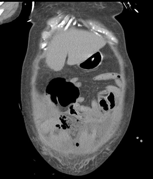Bladder rupture post renal biopsy (Radiopaedia 30863-31572 Coronal non-contrast 14).jpg