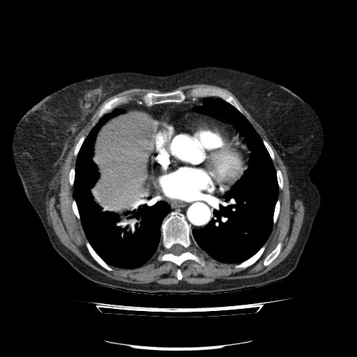 File:Bladder tumor detected on trauma CT (Radiopaedia 51809-57609 A 57).jpg
