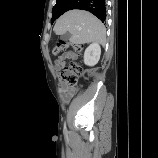 File:Blunt abdominal trauma with solid organ and musculoskelatal injury with active extravasation (Radiopaedia 68364-77895 C 45).jpg