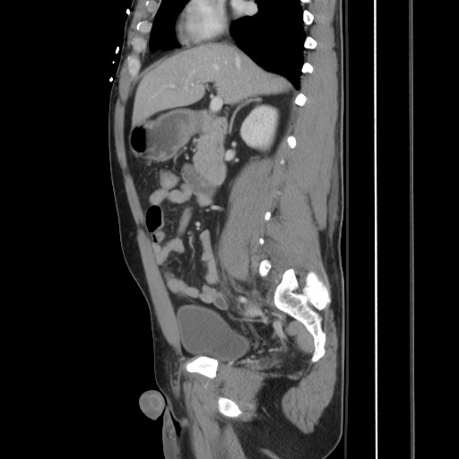 Blunt abdominal trauma with solid organ and musculoskelatal injury with active extravasation (Radiopaedia 68364-77895 C 63).jpg