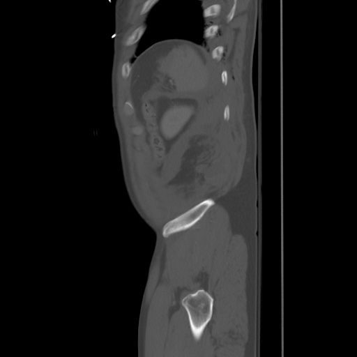 Blunt abdominal trauma with solid organ and musculoskelatal injury with active extravasation (Radiopaedia 68364-77895 Sagittal bone window 99).jpg