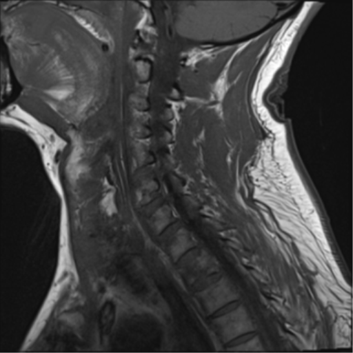 File:Blunt cerebrovascular injury (Radiopaedia 53682-59744 Sagittal T1 5).png