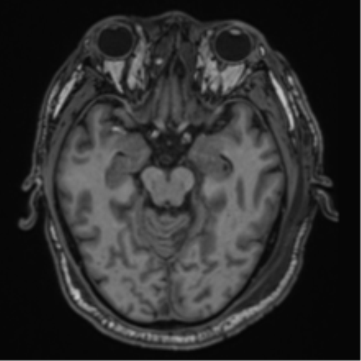 File:Blunt cerebrovascular injury (Radiopaedia 53682-59745 Axial T1 13).png