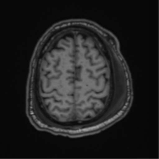 File:Blunt cerebrovascular injury (Radiopaedia 53682-59745 Axial T1 26).png
