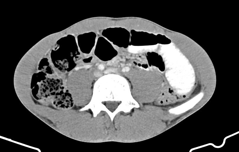 Blunt injury to the small bowel (Radiopaedia 74953-85987 A 116).jpg