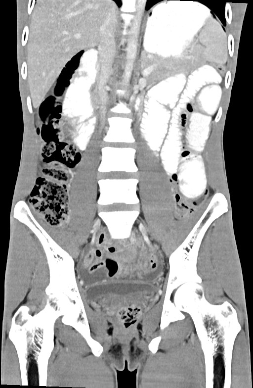 Blunt injury to the small bowel (Radiopaedia 74953-85987 B 55).jpg