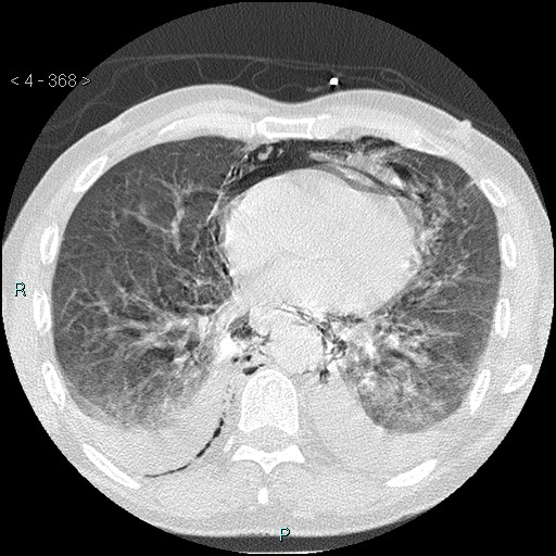 Boerhaave syndrome (Radiopaedia 27683-27897 lung window 67).jpg